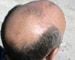Hair loss signals prostate cancer risk