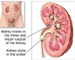 Kidney stones linked to clogged arteries