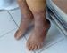 Narrowed leg arteries disable women faster than men