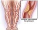 Leg artery disease often goes undetected