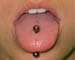 Metal tongue piercings linked to infection risks