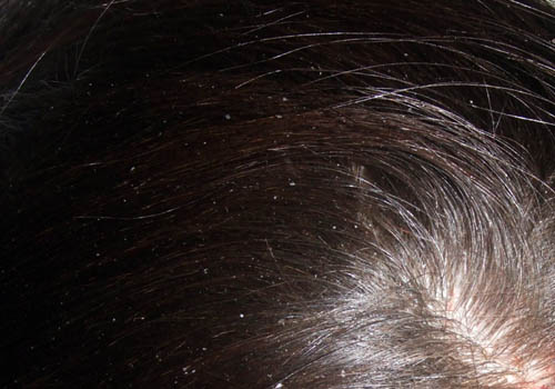 Dandruff