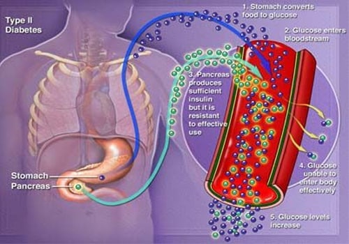 Diabetes mellitus