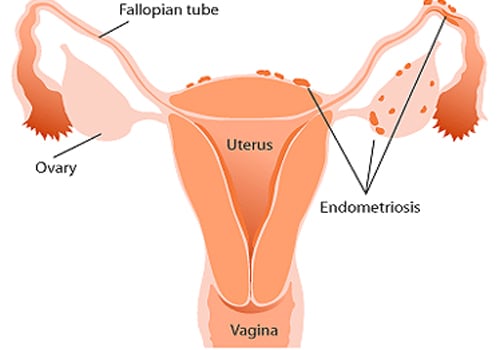 Dyspareunia