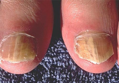Fungal infections of the skin