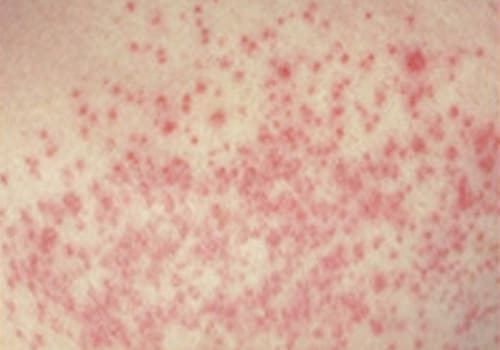 Fungal infections of the skin