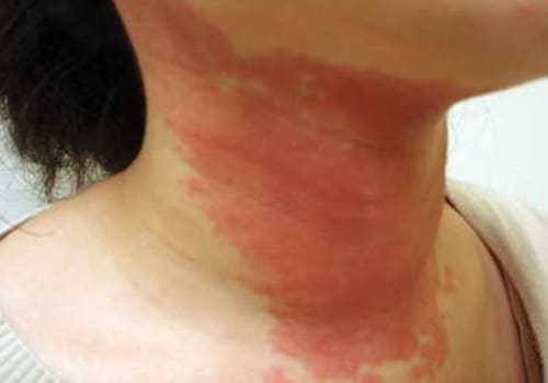 Fungal Rash On Neck