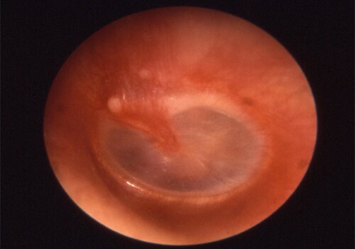 Otitis media