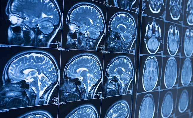 Trying to Understand Why Some Brains Become Haunted