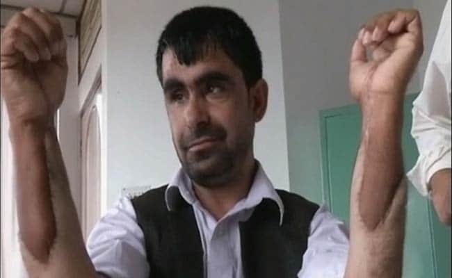 Afghan Military Captain Gets Indian Hands in Transplant