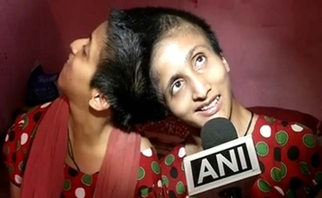 Bihar's Conjoined Twins Saba-Farah Stop Eating After Salman Verdict