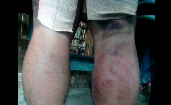 Manipur Teacher Thrashed For Allegedly Caning Student, Hospitalised