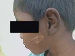 3-Year-Old Burnt With Hot Spoon For 'Not Obeying' Grandparents