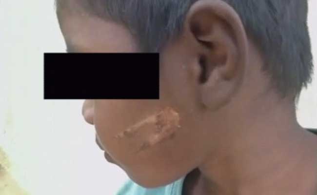 3-Year-Old Burnt With Hot Spoon For 'Not Obeying' Grandparents
