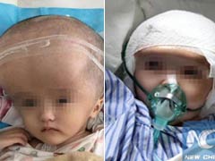 3D Printed Skull Implanted in 3-Year-Old Chinese Girl