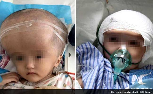 3D Printed Skull Implanted in 3-Year-Old Chinese Girl