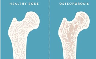 High Prevalence of Osteoporosis Among Indian Men: Survey