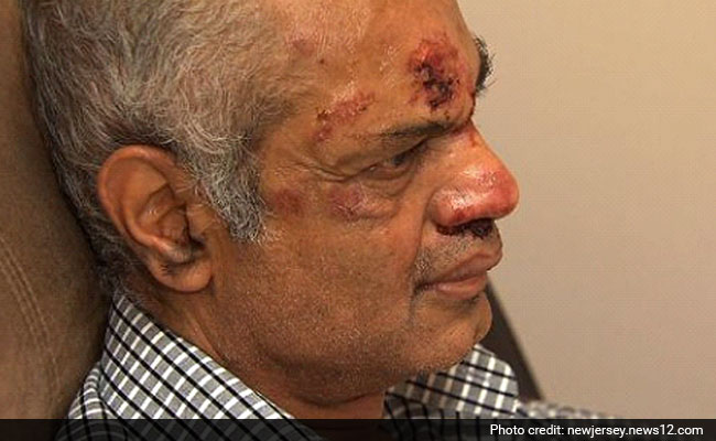 Indian-Origin Man's Teeth Broken in Hate Crime in New Jersey