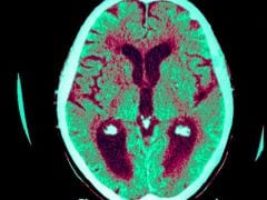 Dementia not the Epidemic it was Feared to be, Say Academics Dementia not the Epidemic it was Feared to be, Say Academics