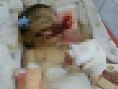 Andhra's Shame: Baby in Hospital Allegedly Bitten by Rats