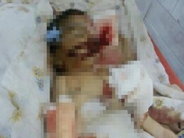 Andhra's Shame: Baby in Hospital Allegedly Bitten by Rats Andhra's Shame: Baby in Hospital Allegedly Bitten by Rats