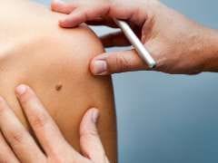 Why You May Want to Get that Mole Checked Out Why You May Want to Get that Mole Checked Out
