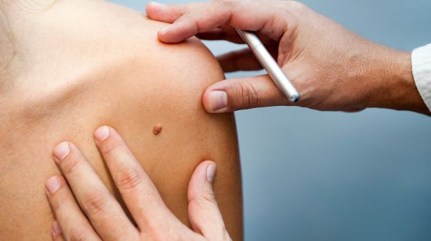 Why You May Want to Get that Mole Checked Out