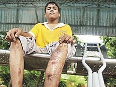 Six 'Make Me Tall' Surgeries Later, Mumbai Teen Can Now Barely Walk