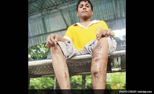 Six 'Make Me Tall' Surgeries Later, Mumbai Teen Can Now Barely Walk