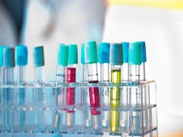 Routine Blood Test May Detect Alzheimer's: Study Routine Blood Test May Detect Alzheimer's: Study