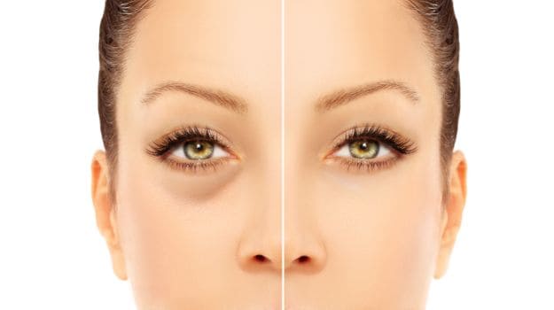 5 Natural Home Remedies To Remove Dark Circles Ndtv Food - 