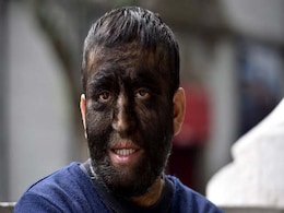 Mexican 'Wolf Man' Battles Isolation of Rare Condition Mexican 'Wolf Man' Battles Isolation of Rare Condition