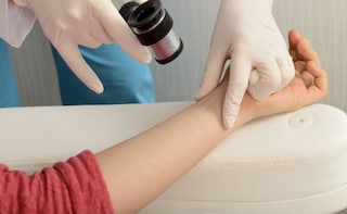 Moles on Your Arm May Indicate Risk of Skin Cancer