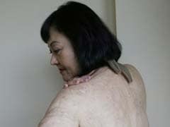 43 Years After the Burns That Made Her the 'Napalm Girl,' Kim Phuc Gets Treatment for Scars