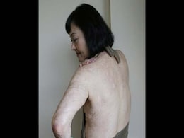 43 Years After the Burns That Made Her the 'Napalm Girl,' Kim Phuc Gets Treatment for Scars 43 Years After the Burns That Made Her the 'Napalm Girl,' Kim Phuc Gets Treatment for Scars