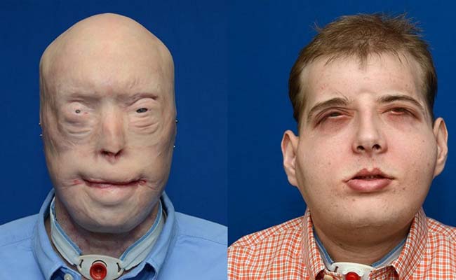 Injured Firefighter Undergoes the World's Most Extensive Face Transplant