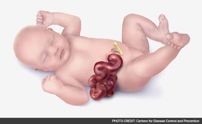 More Babies Are Being Born With Organs Outside Their Bodies; Experts Have No Answers