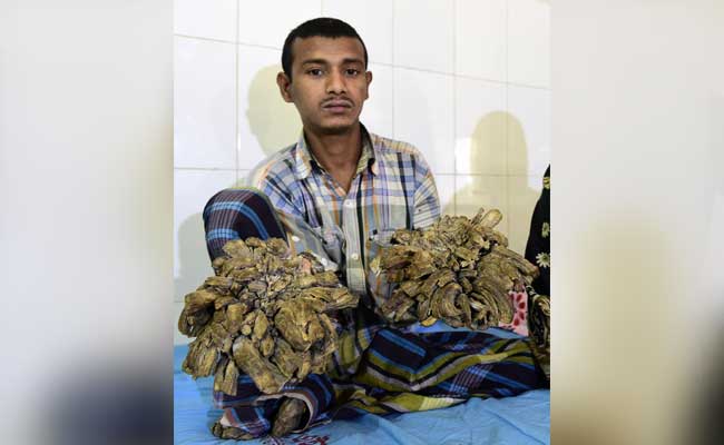 Bangladeshs Tree Man Undergoes Successful Surgery