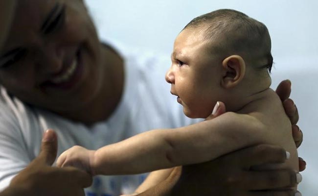 Alternative Therapy Soothes Brazil Babies Suffering Defects Linked To Zika