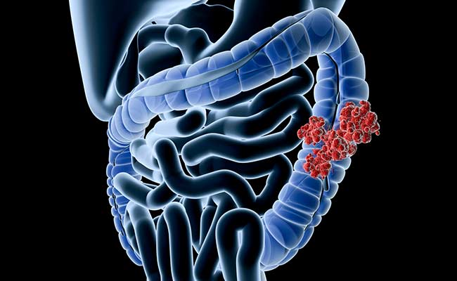 Gene Linked To Colon Cancer Found In 18th Century Mummy