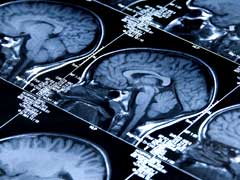 Research Finds Part Of Human Brain That Is Most Affected By COVID-19