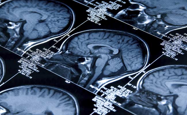 Study: Diabetes in Teens Can Affect the Grey Matter in Their Brain