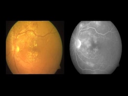 वर्ल्ड हेल्थ-डे पर विशेष : आंखों को इस घातक रोग से बचाने के लिए डायबिटीज को हराना ही होगा... वर्ल्ड हेल्थ-डे पर विशेष : आंखों को इस घातक रोग से बचाने के लिए डायबिटीज को हराना ही होगा...