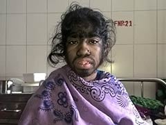 Bangladesh Girl Seeks Help For Rare Excess Hair Condition