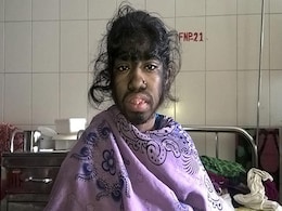 Bangladesh Girl Seeks Help For Rare Excess Hair Condition Bangladesh Girl Seeks Help For Rare Excess Hair Condition