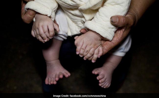 Meet Hong Hong, Chinese Boy Born With 31 Fingers And Toes