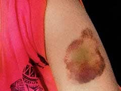 Pune: Woman Thrashed For 'Wearing Short Dress, Roaming With Men'
