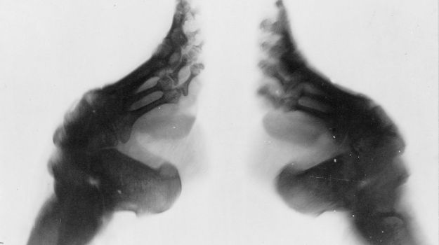 x ray chinese feet