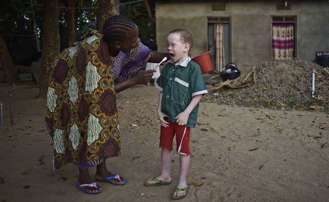 Africa Summit Tackles Violence Against Albinos