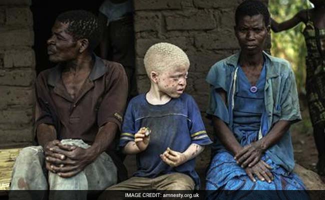 End Impunity For Attacks On Albinos, Euro MPs Urge